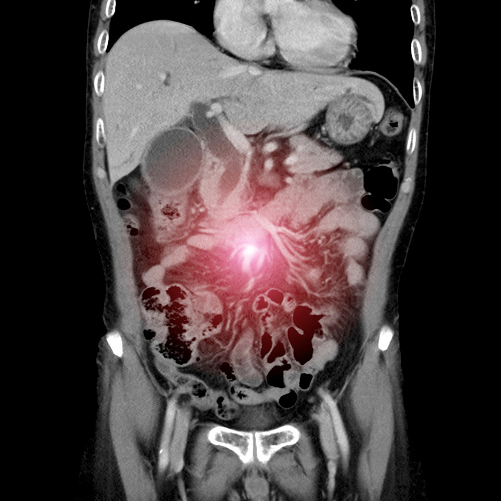 Cirugia de la carcinomatosis peritoneal