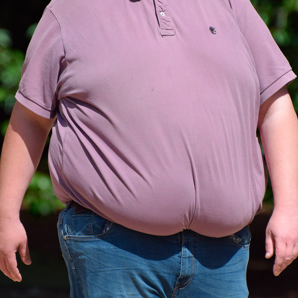 Cirugia de obesidad y metabolica